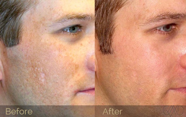 Microneedling